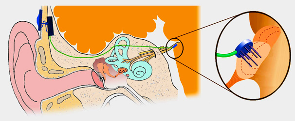 brainstem_implant.jpg