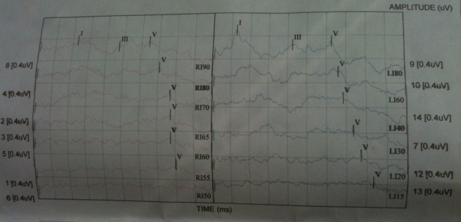 evoked potential report1
